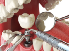 When Is It Best To Get A Dental Implant